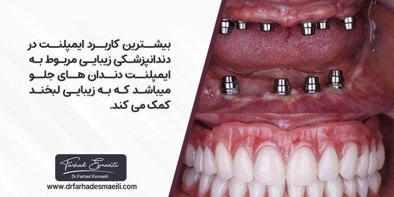 دندانپزشکی زیبایی با ایمپلنت دندان