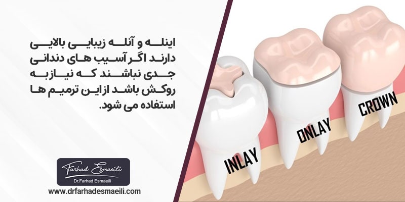 اینله و آنله عملکرد و زیبایی بالایی در حیطه دندانپزشکی ترمیمی و زیبایی دارند اگر آسیب های دندانی آنقدر جدی نباشند که نیاز به روکش باشد دندانپزشک از این ترمیم ها استفاده می کند. 