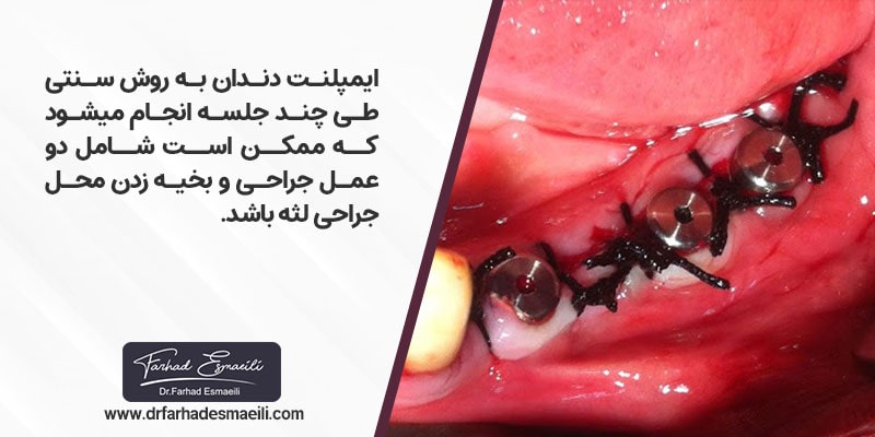 ایمپلنت دندان به روش سنتی طی چند جلسه انجام می شود که ممکن است شامل دو عمل جراحی و بخیه زدن محل جراحی لثه باشد.