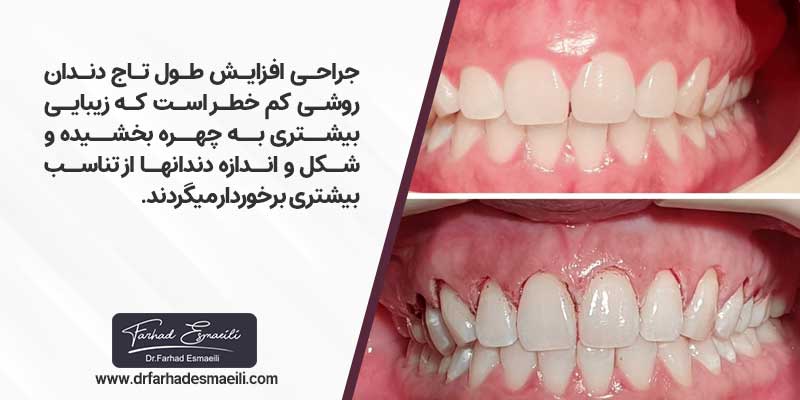 جراحی افزایش طول تاج دندان روشی کم خطر است که زیبایی بیشتری به چهره بخشیده و شکل و اندازه دندانها از تناسب بیشتری برخوردار می گردند.