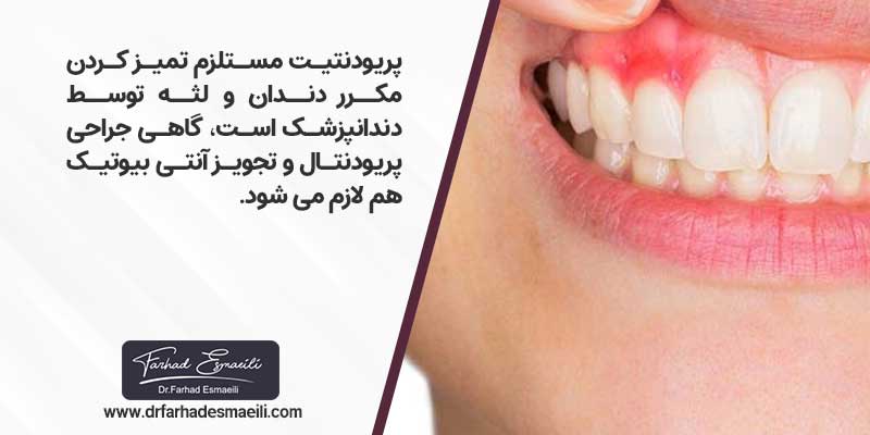 بیماری پریودنتیت لثه مستلزم تمیز کردن مکرر دندان و لثه توسط دندانپزشک است، گاهی جراحی پریودنتال و تجویز آنتی بیوتیک هم لازم می شود.