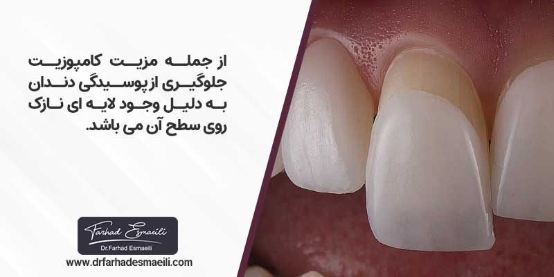 از جمله مزیت کامپوزیت جلوگیری از پوسیدگی دندان به دلیل وجود لایه ای نازک روی سطح آن می باشد.