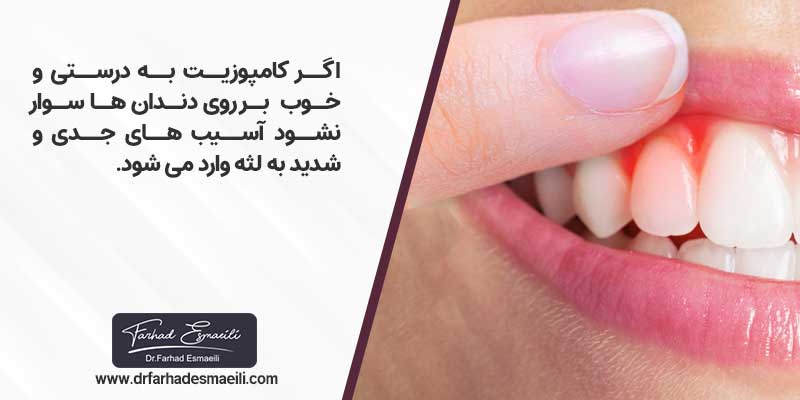 از معایب کامپوزیت این است که اگر کامپوزیت به درستی و خوب  بر روی دندان ها سوار نشود آسیب های جدی و شدید به لثه وارد می شود.