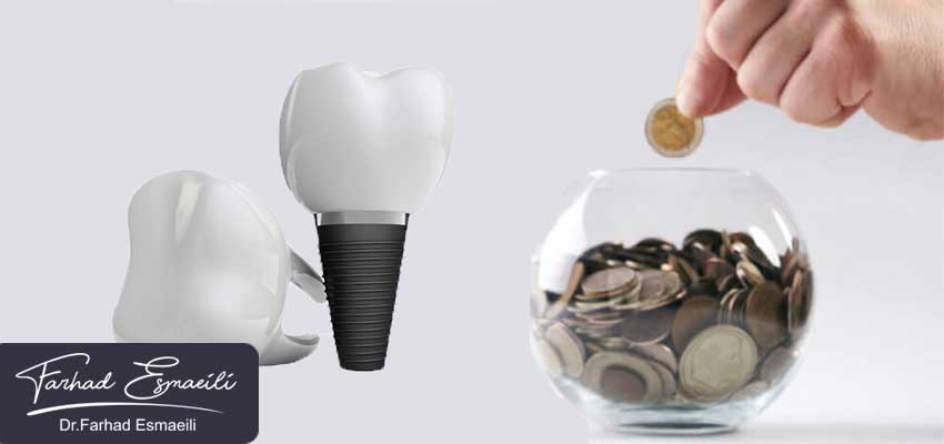 قیمت ایمپلنت دندان در سال 1402