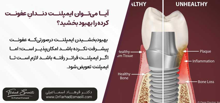 آیا میتوان یک ایمپلنت دندانِ عفونت کرده را بهبود بخشید؟