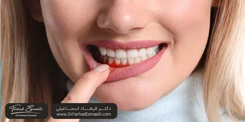 آیا ایمپلنت ممکن است باعث سرطان شود؟ | دکتر فرهاد اسماعیلی متخصص ایمپلنت در اصفهان