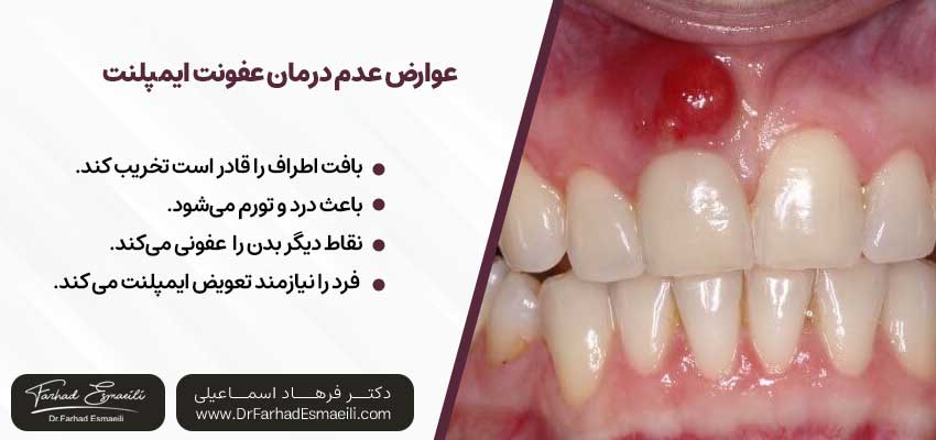عوارض عدم درمان عفونت ایمپلنت دندان