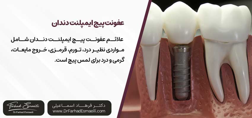 عفونت پیچ ایمپلنت دندان