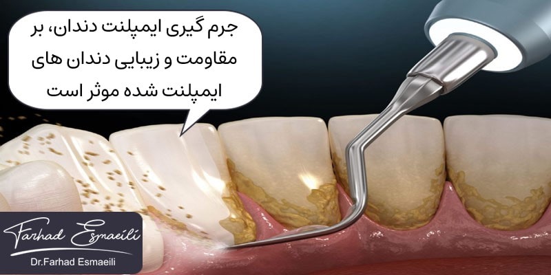 مقاومت و زیبایی ایمپلنت دندان با جرم گیری