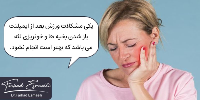 ورزش کردن بعد از ایمپلنت دندان منجر به باز شدن بخیه ها می شود