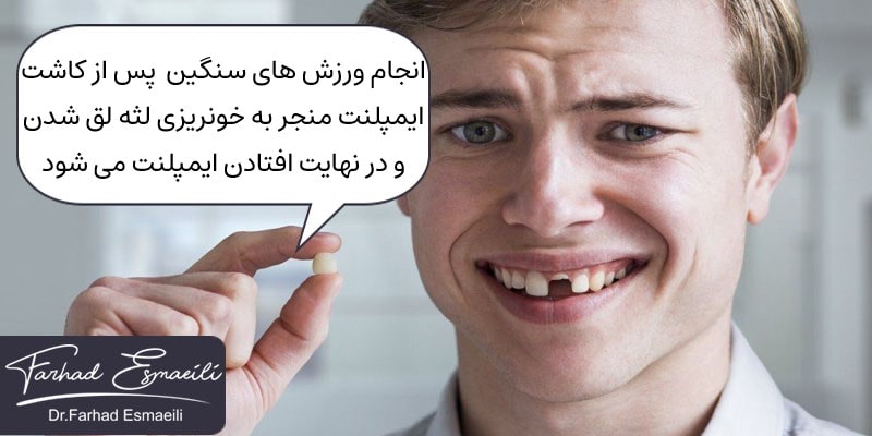 افتادن ایمپلنت دندان پس از ورزش کردن