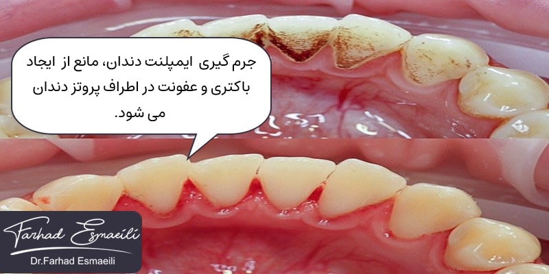 جرم گیری ایمپلنت دندان مانع از وجود باکتری و عفونت اطراف پروتز دندان می شود.