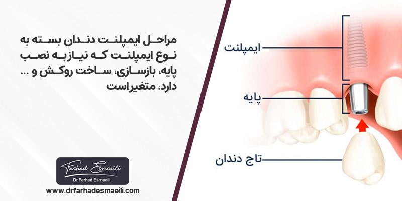 مراحل کاشت دندان بسته به نوع ایمپلنت متغیر است