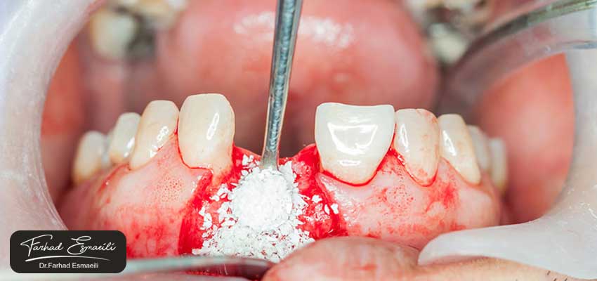 آیا ورم بعد از ایمپلنت در پیوند استخوان، طبیعی است؟