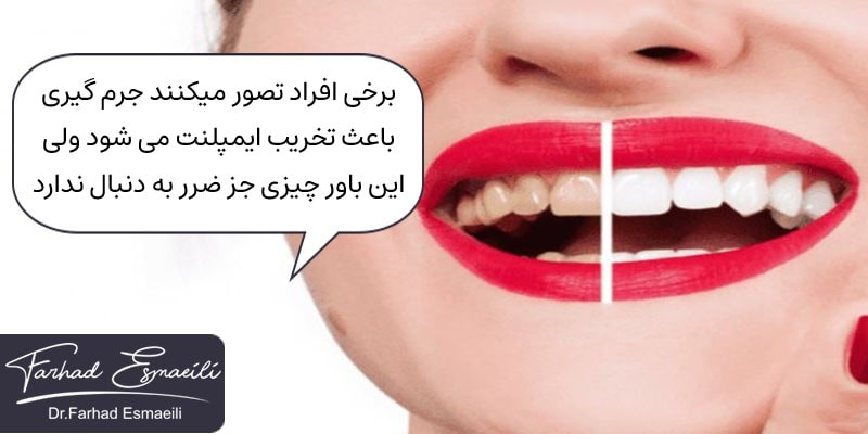 باورهای غلط در مورد جرم گیری ایمپلنت دندان