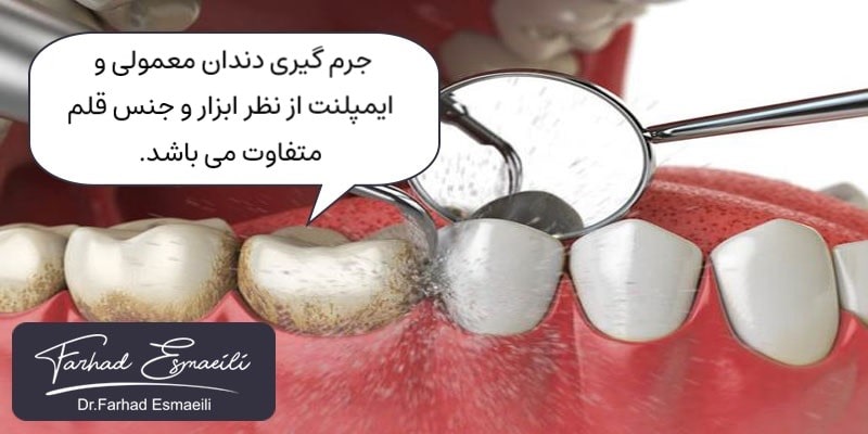جرم گیری دندان پس از کاشت ایمپلنت