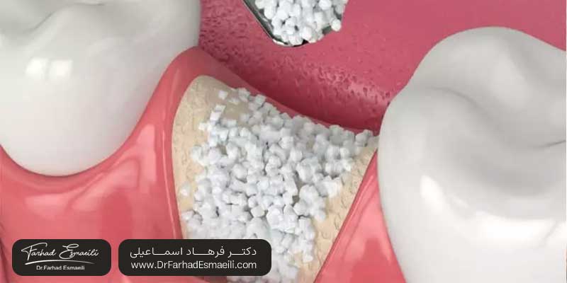 آیا پیوند استخوان در ایمپلنت سرطان‌زاست؟ | دکتر فرهاد اسماعیلی متخصص ایمپلنت در اصفهان