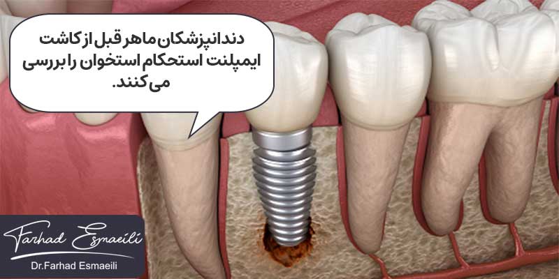 ایمپلنت ناموفق و شکست آن به دلیل استحکام کم استخوان