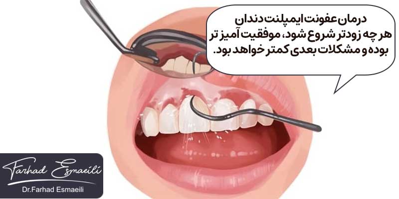 درمان عفونت ایمپلنت دندان