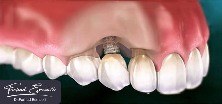 عفونت ایمپلنت دندان، شایع ترین عوارض پس از کاشت ایمپلنت