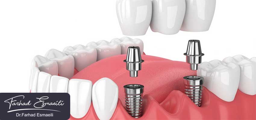 درد های پس از کاشت ایمپلنت دندان
