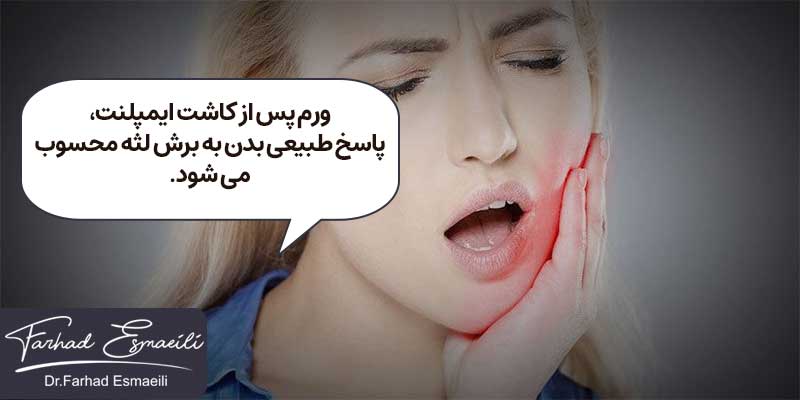 ورم پس از کاشت ایمپلنت از عوارض طبیعی ایمپلنت دندان