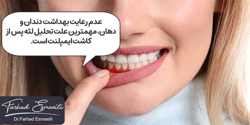 تحلیل لثه پس از کاشت ایمپلنت از عوارض ایمپلنت دندان