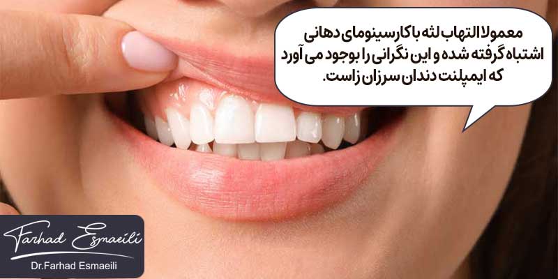 التهاب لثه با کارسینومای دهانی اشتباه گرفته می شود.