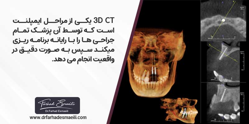 3d ct یکی از مهم ترین مراحل کاشت ایمپلنت است