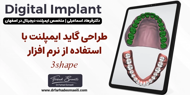 گاید جراحی و آمادهسازی پیشرفته در دندانپزشکی دیجیتال اصفهان با دکتر فرهاد اسماعیلی