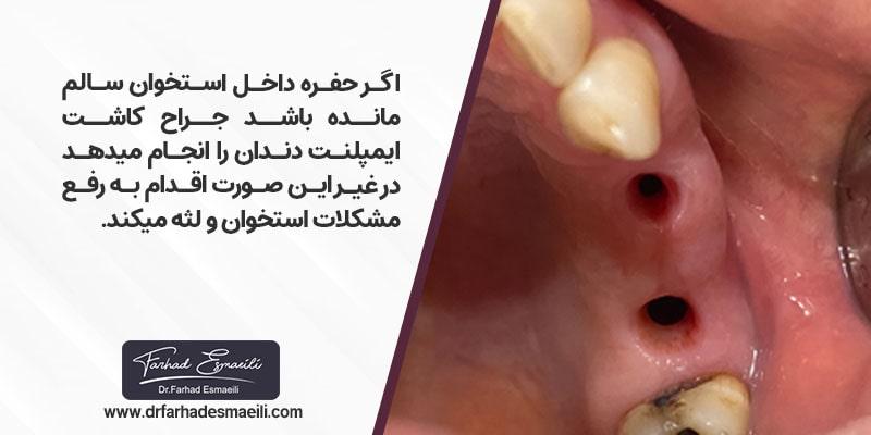 اگر حفره داخل استخوان سالم مانده باشد جراح کاشت ایمپلنت دندان را انجام می دهد در غیر این صورت اقدام به رفع مشکلات موجود در استخوان و لثه می کند.