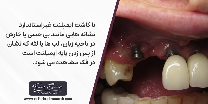 با کاشت ایمپلنت از مارک نامرغوب یا غیراستاندارد، پس از مدت کوتاهی نشانه هایی مانند بی حسی یا خارش در ناحیه زبان، لب ها یا لثه که نشاندهنده پس زدن پایه ایمپلنت است در فک مشاهده می شود.