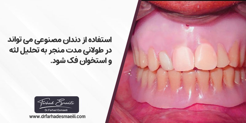 استفاده از دندان مصنوعی نیز می تواند در طولانی مدت منجر به تحلیل لثه و استخوان فک شود.