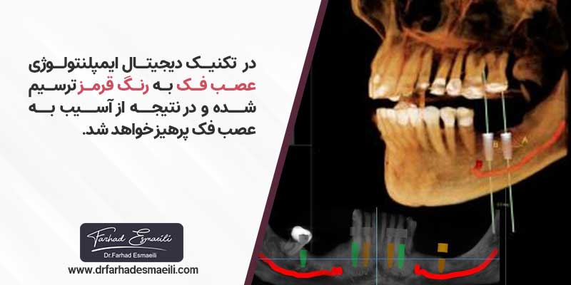 کاربرد دیجیتال ایمپلنتولوژی در دندانپزشکی دیجیتال
