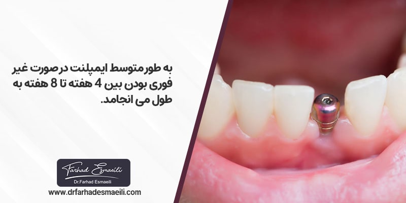 مراحل ایمپلنت دندان چقدر طول می کشد؟