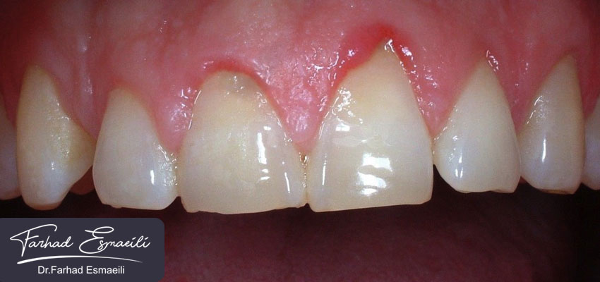 تحلیل لثه پس از کاشت ایمپلنت دندان