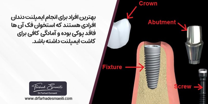 یکی از شرایط لازم برای انجام کاشت ایمپلنت این است که استخوان فک فاقد پوکی و پوسیدگی باشد