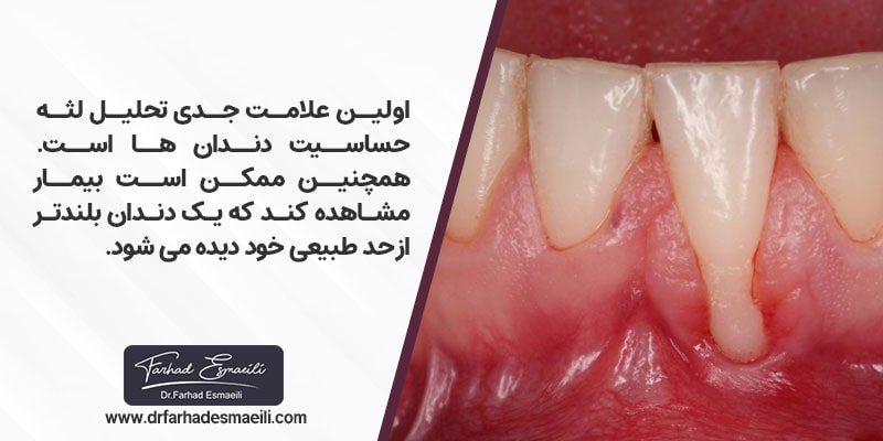 اولین علامت جدی تحلیل لثه و فک حساسیت دندان ها می باشد. همچنین ممکن است بیمار مشاهده کند که یک دندان بلندتر از حد طبیعی خود دیده می شود.