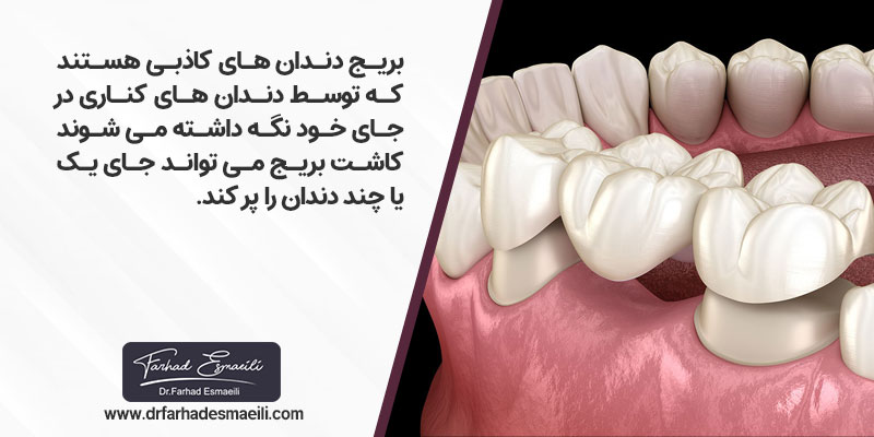 بریج یا پل دندانی(Dental Bridge)، دندان های کاذبی هستند که توسط دندان های کناری دندان از دست رفته در جای خود نگه داشته می شوند.بریج می تواند جای یک یا چند دندان از دست رفته را پر کند.