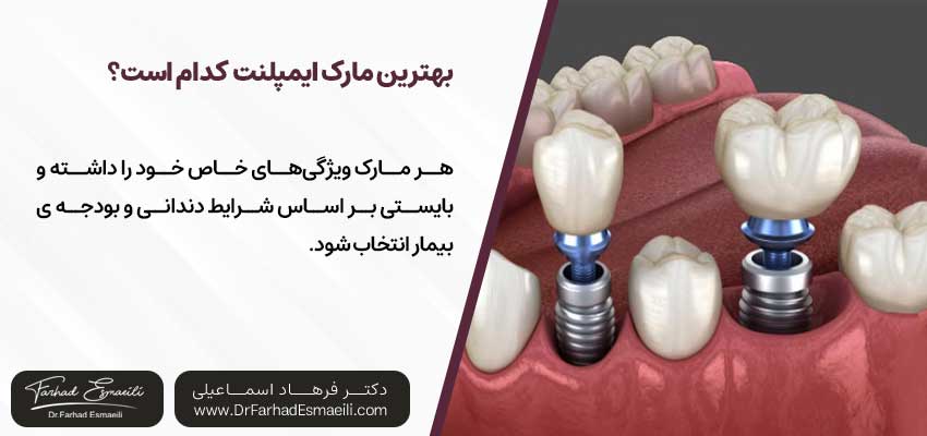بهترین مارک ایمپلنت دندانی کدام است؟