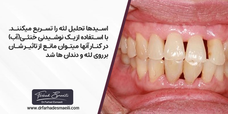 اسیدها تحلیل لثه را تسریع میکنند استفاده از یک نوشیدنی خنثی (آب) در کنار نوشیدنی اسیدی میتوانید تأثیر آنها را روی دندان و لثه از بین ببرید و مانع آسیب شوید.