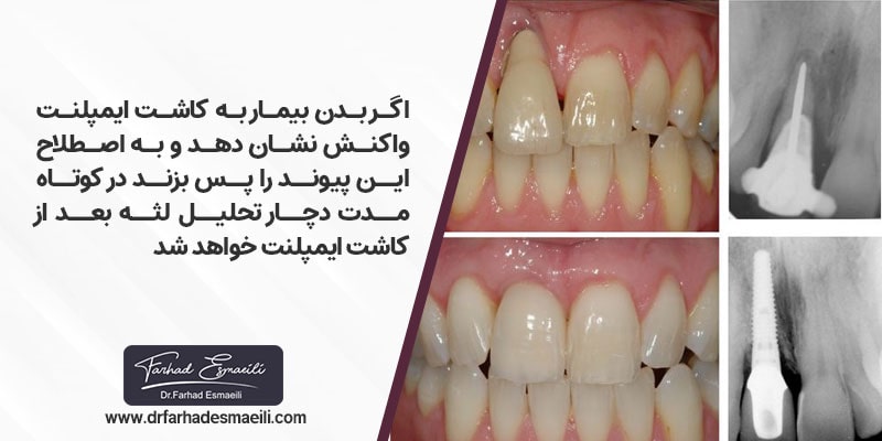 اگر بدن بیمار به کاشت ایمپلنت واکنش نشان دهد و به اصطلاح این پیوند را پس بزند در کوتاه مدت دچار تحلیل لثه بعد از کاشت ایمپلنت خواهد شد