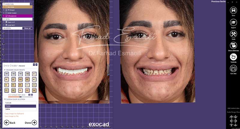 نمونه اصلاح طرح لبخند دیجیتال