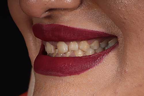نمونه اصلاح طرح لبخند توسط دکتر اسماعیلی