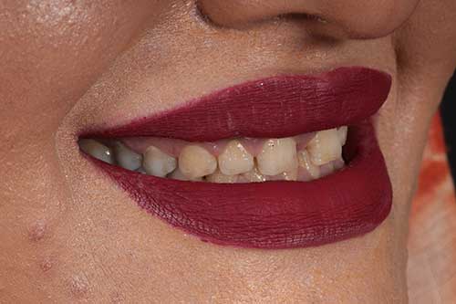 نمونه اصلاح طرح لبخند توسط دکتر اسماعیلی