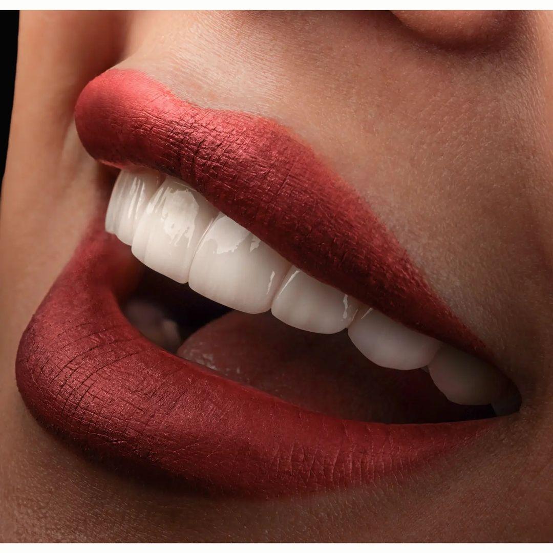 لمینیت سرامیکی در اصفهان توسط دکتر فرهاد اسماعیلی دندانپزشک زیبایی