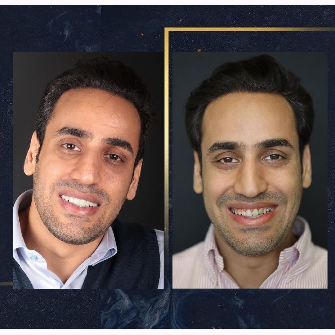 لمینیت سرامیکی در اصفهان توسط دکتر فرهاد اسماعیلی دندانپزشک زیبایی