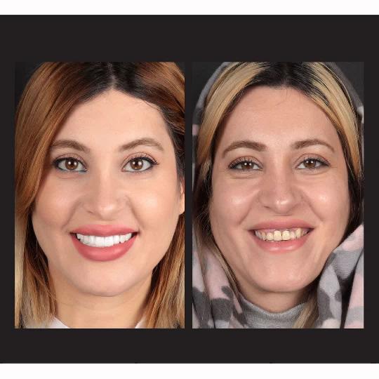 لمینیت سرامیکی در اصفهان توسط دکتر فرهاد اسماعیلی دندانپزشک زیبایی