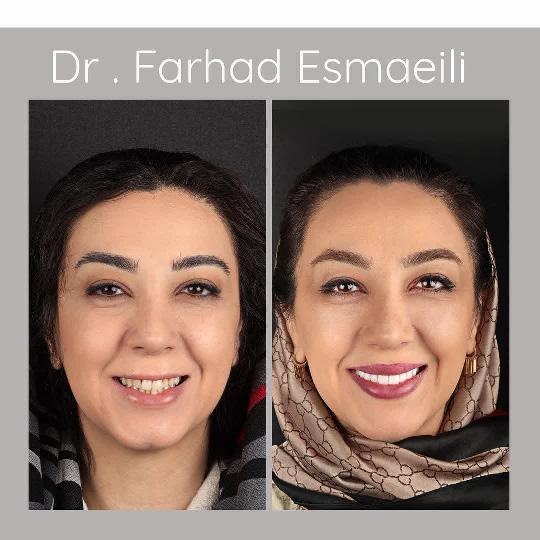 لمینیت سرامیکی در اصفهان توسط دکتر فرهاد اسماعیلی دندانپزشک زیبایی