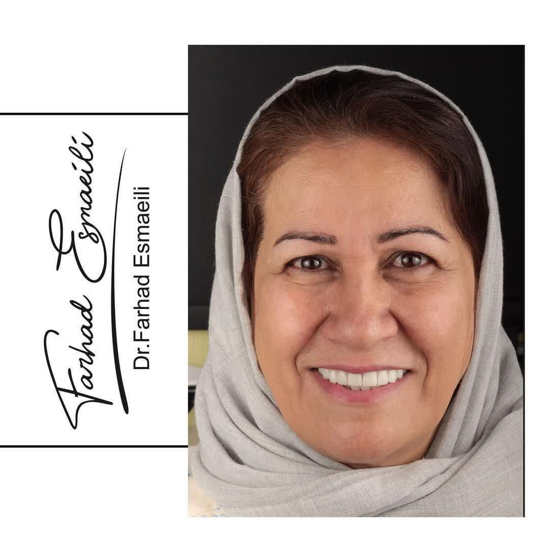 لمینیت سرامیکی در اصفهان توسط دکتر فرهاد اسماعیلی دندانپزشک زیبایی